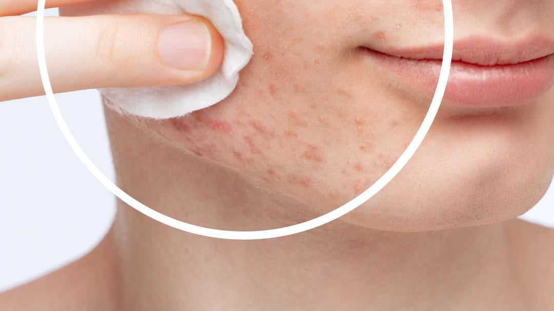 Alles over de onzuivere huid: oorzaken, tips & producten