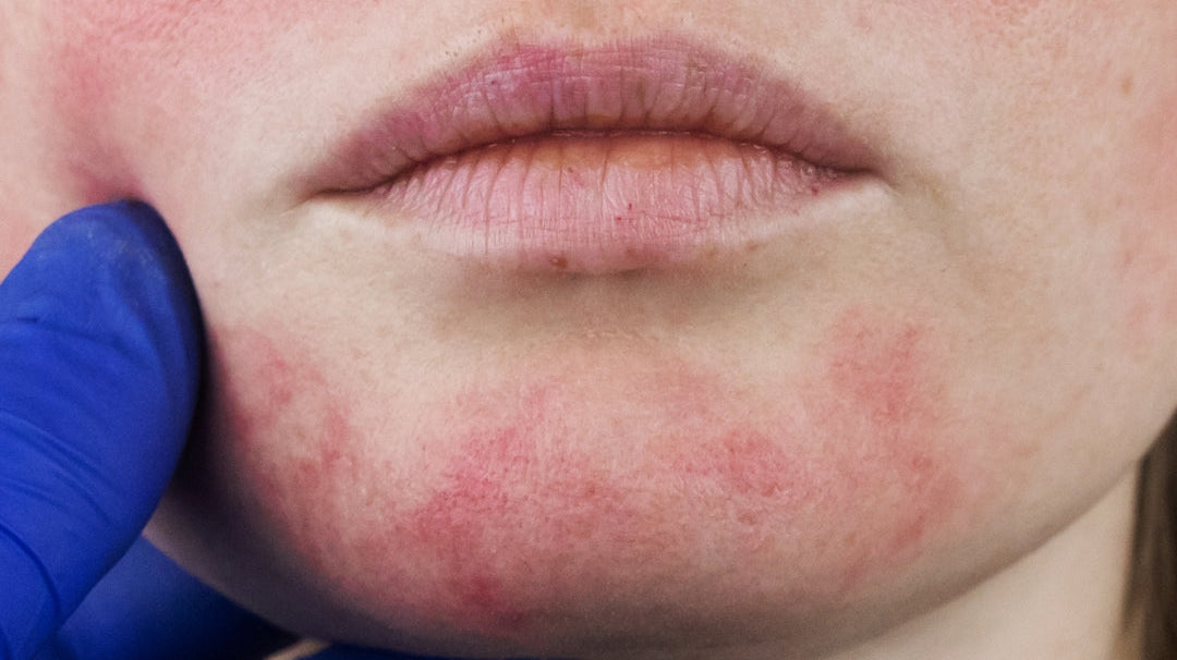 Wat is rosacea?