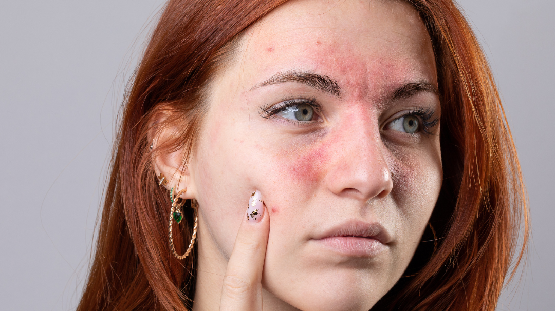 Eczeem oorzaken: wat veroorzaakt eczeem en hoe herken je jouw triggers?