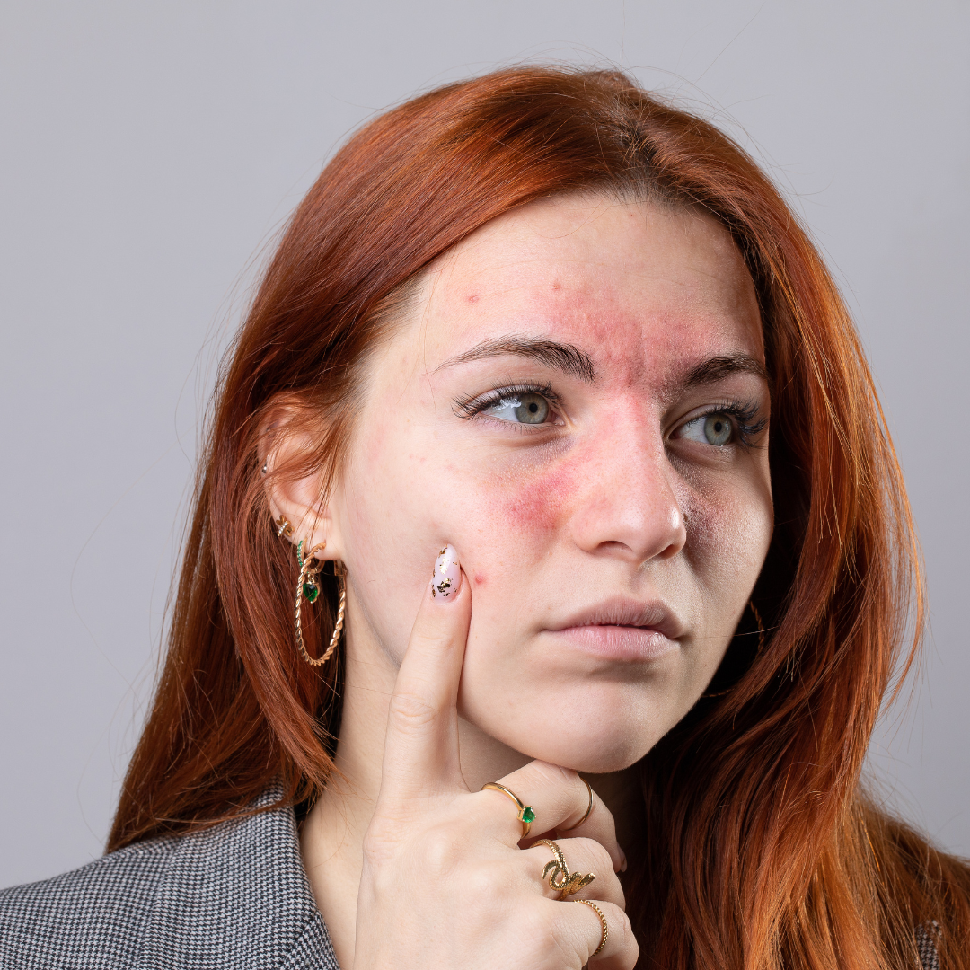 Eczeem oorzaken: wat veroorzaakt eczeem en hoe herken je jouw triggers?